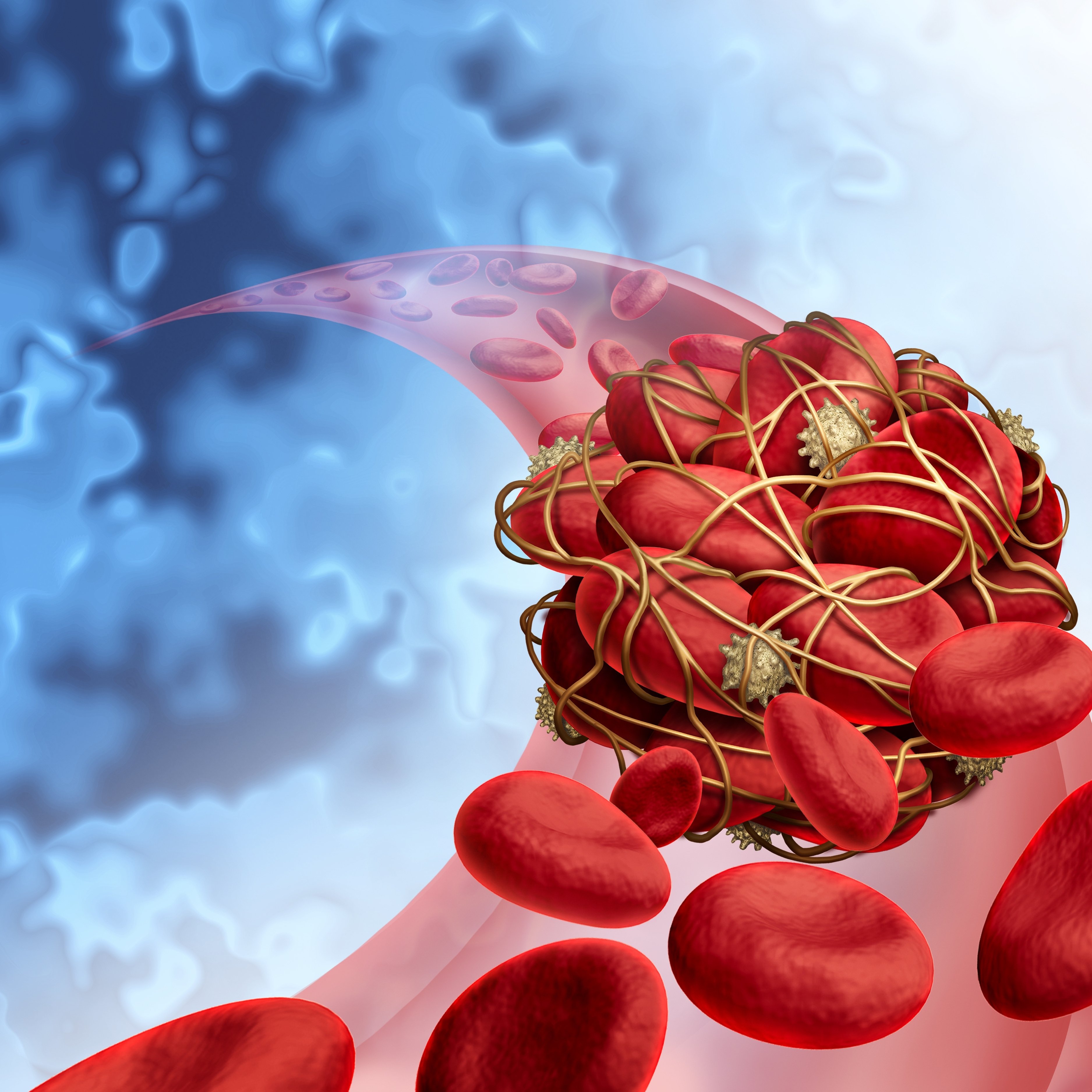 antiphospholipid-syndrome